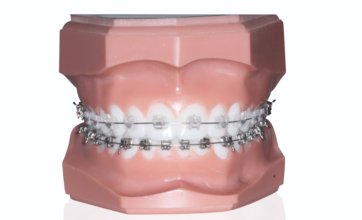 clear ceramic braces on model