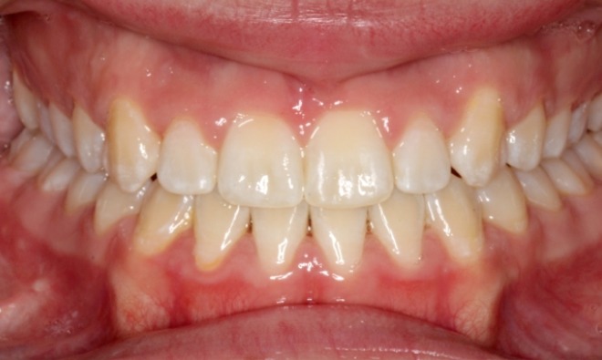 after Image