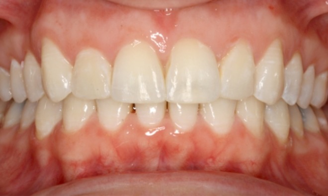 after Image