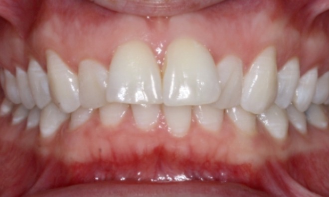 before Image