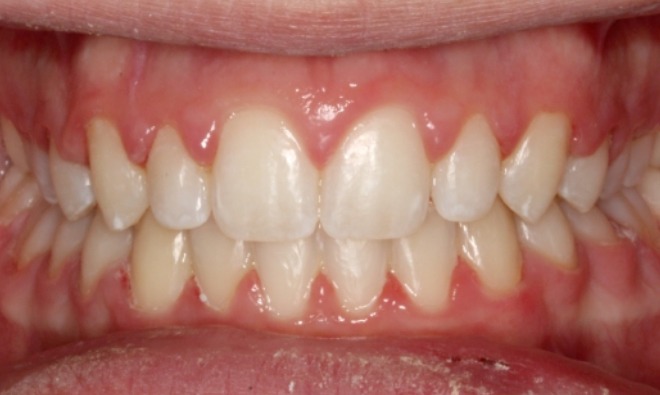 after Image