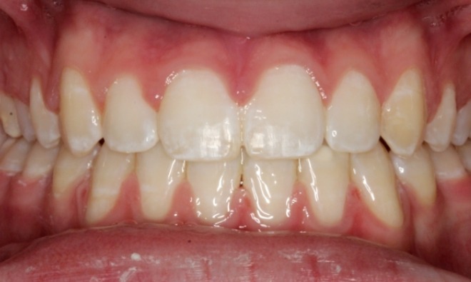 after Image
