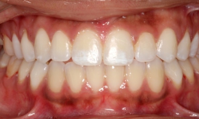 after Image