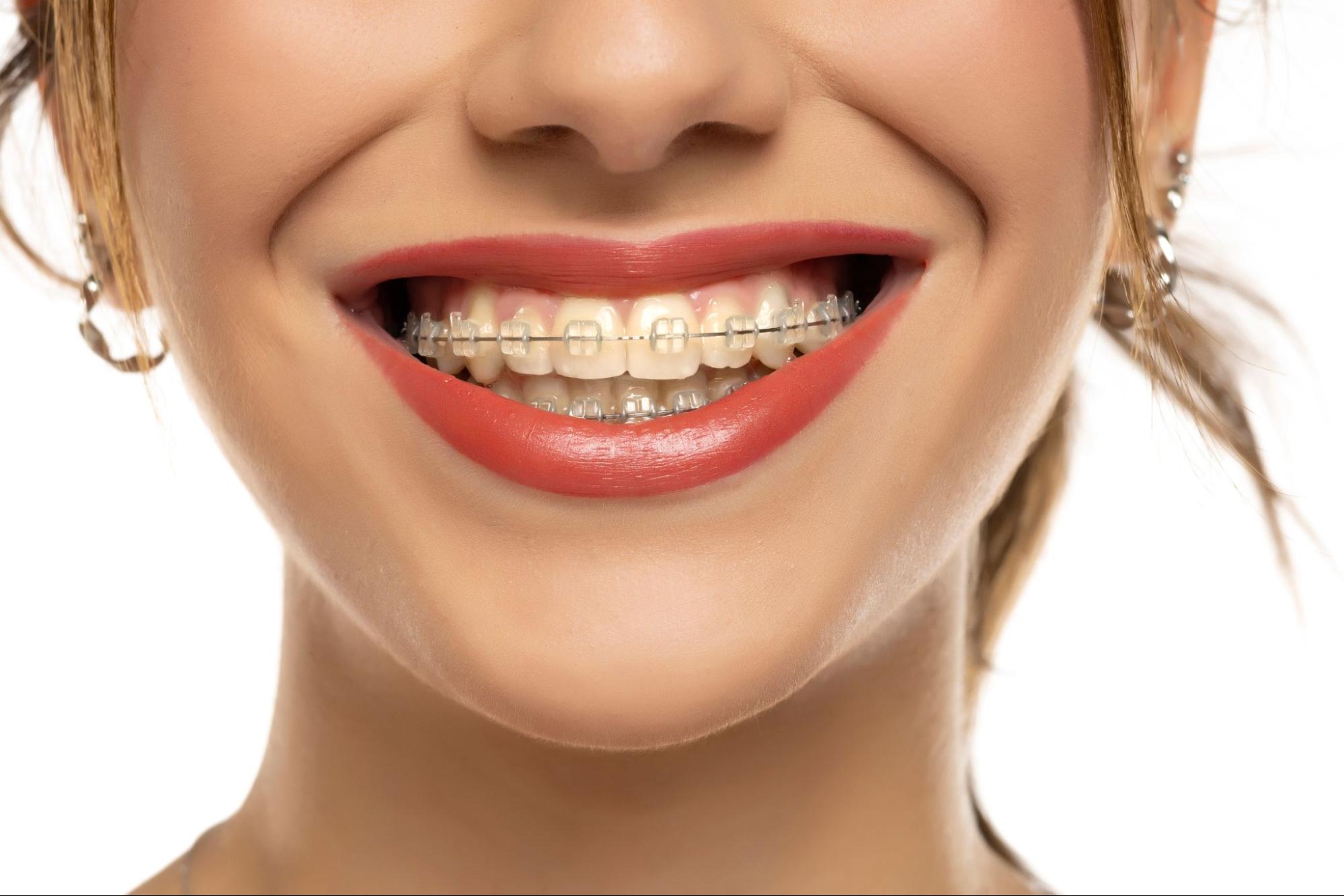 A Beginner’s Guide to Clear Braces